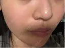 ハイフ（顔） Natural Skin Clinic 自由ヶ丘院 DAY 4 サムネイル用