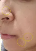 ほくろ・いぼ切除（肌） CLINIC W DAY 13 サムネイル用