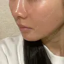 ヒアルロン酸注入（頬） / ヒアルロン酸注入（鼻翼基部） KIMI CLINIC 形成・美容外科 DAY 4 サムネイル用