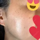 ピコスポット Fellez Clinic【フェルズクリニック】 DAY 6 サムネイル用