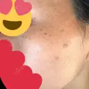 ピコスポット Fellez Clinic【フェルズクリニック】 DAY 6 サムネイル用