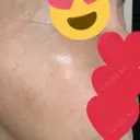 ピコスポット Fellez Clinic【フェルズクリニック】 DAY 8 サムネイル用