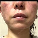 光治療（フォトフェイシャルなど） / RF（高周波）たるみ治療 / ルメッカ / インモード BITO BEAUTY CLINIC DAY 2 サムネイル用