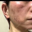 光治療（フォトフェイシャルなど） / RF（高周波）たるみ治療 / ルメッカ / インモード BITO BEAUTY CLINIC DAY 2 サムネイル用