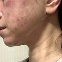 光治療（フォトフェイシャルなど） / RF（高周波）たるみ治療 / ルメッカ / インモード BITO BEAUTY CLINIC DAY 2 サムネイル用