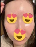 毛穴洗浄（ハイドラフェイシャルなど） / ピコレーザートーニング（美白・肝斑） 表参道ウィズ・クリニック AFTER サムネイル用