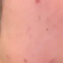 ほくろ・いぼ除去レーザー（肌） 心斎橋KT美容クリニック DAY 5 サムネイル用