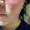 その他（肌） ルラ美容クリニック 大阪本院 DAY 1 サムネイル用