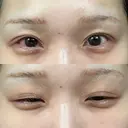 ヒアルロン酸注入（涙袋） 小倉美容外科/美容皮膚科 ビラビューティークリニック DAY 4 サムネイル用