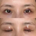 二重切開 / 眼瞼下垂（切開） / スレッドノーズ / ヒアルロン酸注入（鼻翼基部） オーキッド美容クリニック東京御徒町 AFTER サムネイル用