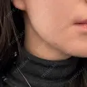 糸リフト / 脂肪吸引（顔） / 脂肪吸引（二の腕） / 脂肪吸引（脚） / 脂肪吸引（お腹） / 脂肪吸引（お尻） / 脂肪吸引（腰） / 脂肪吸引（背中） / 脂肪吸引（肩） ヴェルトラクリニック 新宿院 AFTER サムネイル用