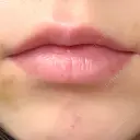 ヒアルロン酸注入（唇） HAAB×DREAM BEAUTY CLINIC 大阪梅田院 AFTER サムネイル用