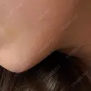 ヒアルロン酸注入（あご） KIMI CLINIC 形成・美容外科 AFTER サムネイル用