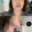 ボトックス（エラ・小顔） / ボトックス（肩） サラ美容外科 DAY 17 サムネイル用