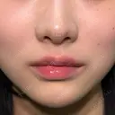 ヒアルロン酸注入（涙袋） / ヒアルロン酸注入（鼻） / ヒアルロン酸注入（あご） / ボトックス（エラ・小顔） / ヒアルロン酸注入（唇） / ヒアルロン酸注入（頬） HAAB×DREAM BEAUTY CLINIC 大阪梅田院 DAY 0 サムネイル用