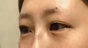 ヒアルロン酸注入（涙袋） ルラ美容クリニック 宇都宮院 DAY 0 サムネイル用