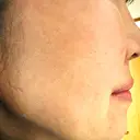 エレクトロポレーション / ルメッカ ON-CLINIC Beauty DAY 3 サムネイル用