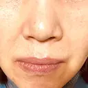 エレクトロポレーション / ルメッカ ON-CLINIC Beauty DAY 3 サムネイル用