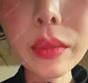 肌ヒアルロン酸注入（たるみ・シワ改善） HAAB×DREAM BEAUTY CLINIC 大阪梅田院 DAY 1 サムネイル用