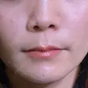 ヒアルロン酸注入（鼻翼基部） / ピーリング（ニキビ・毛穴） ルラ美容クリニック 宇都宮院 DAY 1 サムネイル用