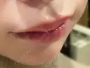 口唇縮小術 Stand by Beauty Clinic DAY 10 サムネイル用