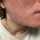 サブシジョン アモーレクリニック 大阪院 AFTER サムネイル用