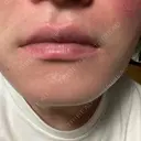 サブシジョン アモーレクリニック 大阪院 DAY 0 サムネイル用