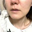 美白レーザー / ピーリング（ハリ・ツヤ） メディアージュクリニック 大阪梅田院 DAY 0 サムネイル用