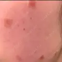 ほくろ・いぼ除去レーザー（肌） 心斎橋KT美容クリニック DAY 6 サムネイル用