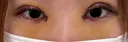 二重埋没 / 目頭切開 湘南美容クリニック 千葉センシティ院 DAY 5 サムネイル用