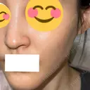 ピコスポット G MEDICAL ART クリニック 新宿院 DAY 6 サムネイル用