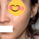 ピコスポット G MEDICAL ART クリニック 新宿院 DAY 9 サムネイル用