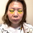 クマ治療 / 小鼻縮小（非切開） / ボトックス（あご） / ボトックス（エラ・小顔） / ボトックス（口角） TCB東京中央美容外科 新潟院 AFTER サムネイル用