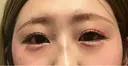 ヒアルロン酸注入（涙袋） ルラ美容クリニック 宇都宮院 AFTER サムネイル用