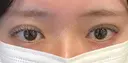 二重埋没 EMMA CLINIC（エマクリニック） DAY 4 サムネイル用