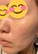 肌育注射（ジュベルックなど） 城本クリニック 豊橋院 DAY 12 サムネイル用
