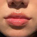 ヒアルロン酸注入（唇） メディカルアルファクリニック DAY 1 サムネイル用