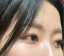 二重埋没 / その他（目元） LUHO（ルホ）美容外科 AFTER サムネイル用