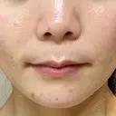 ヒアルロン酸注入（鼻翼基部） / ピーリング（ニキビ・毛穴） ルラ美容クリニック 宇都宮院 AFTER サムネイル用