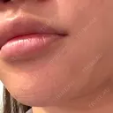 脂肪吸引（顔） プライベートスキンクリニック 梅田本院 DAY 0 サムネイル用