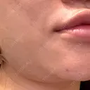 脂肪吸引（顔） プライベートスキンクリニック 梅田本院 DAY 0 サムネイル用