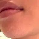 脂肪吸引（顔） プライベートスキンクリニック 梅田本院 AFTER サムネイル用