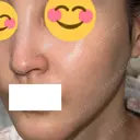 ピコスポット G MEDICAL ART クリニック 新宿院 AFTER サムネイル用