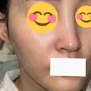 ピコスポット G MEDICAL ART クリニック 新宿院 DAY 10 サムネイル用