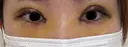 二重埋没 / 目頭切開 湘南美容クリニック 千葉センシティ院 DAY 6 サムネイル用