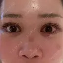 ヒアルロン酸注入（涙袋） / ほくろ・いぼ除去レーザー（肌） プライベートスキンクリニック 梅田本院 DAY 3 サムネイル用