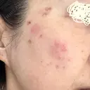 プラセンタ注射 / シミ取りレーザー S-Laboクリニック 渋谷院 DAY 5 サムネイル用