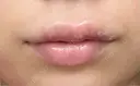 口唇縮小術 博多美容外科/美容皮膚科 ビラビューティークリニック DAY 14 サムネイル用