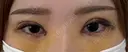 二重埋没 / 目頭切開 湘南美容クリニック 千葉センシティ院 DAY 7 サムネイル用