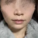 ボトックス（エラ・小顔） / RF（高周波）たるみ治療 大美会クリニック 梅田院 DAY 0 サムネイル用